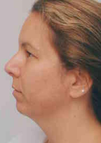 Chin Implant