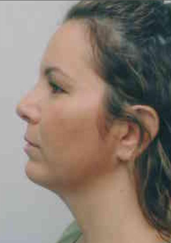 Chin Implant
