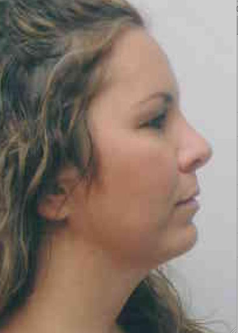 Chin Implant