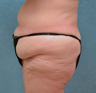 Circumferential Body Lift