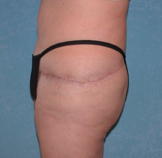 Circumferential Body Lift