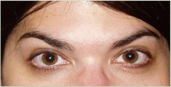Botox