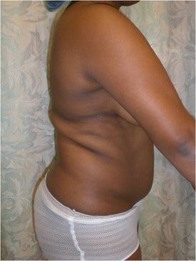 Laser Lipo