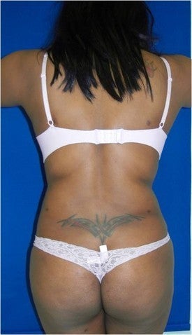 Laser Lipo
