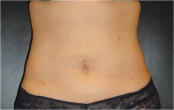 SmartLipo MPX