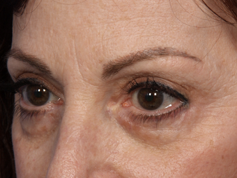 Restylane