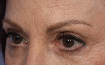 Restylane