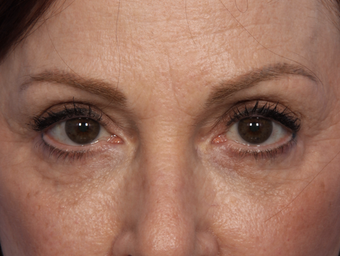 Restylane