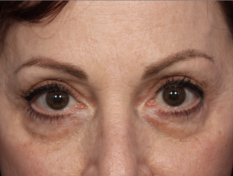 Restylane