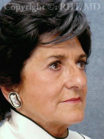 Laser resurfacing (ablative Erbium-YAG/CO2)