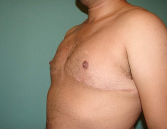 FTM "Top Surgery" Chest Masculinization