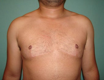 FTM "Top Surgery" Chest Masculinization