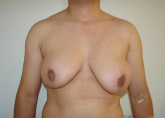 FTM "Top Surgery" Chest Masculinization