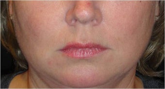 Juvederm