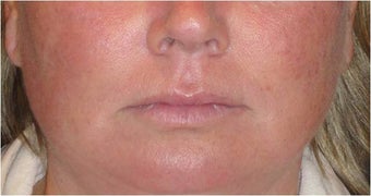 Juvederm