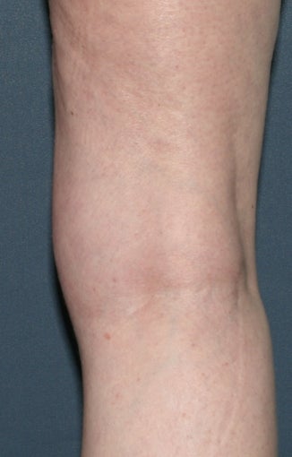 Before & After Leg Vein Treatment in San Diego 