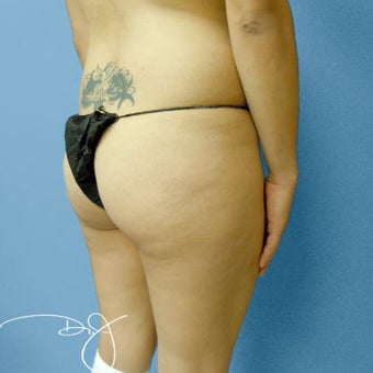 Butt Augmentation