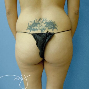 Butt Augmentation