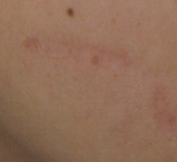 Traumatic Facial Scar after 6 Treatments with the 1540 Lux Fractional Laser