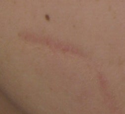 Traumatic Facial Scar after 6 Treatments with the 1540 Lux Fractional Laser