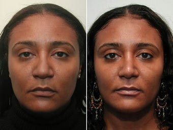 African American Rhinoplasty