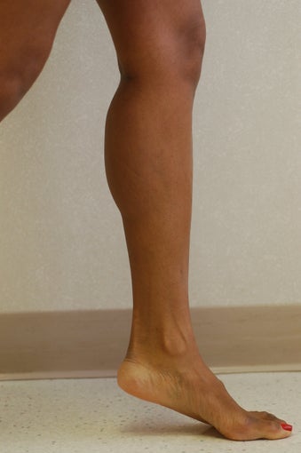 Calf Implants