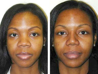 African American Rhinoplasty