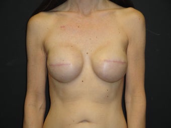 Implant-based breast reconstruction