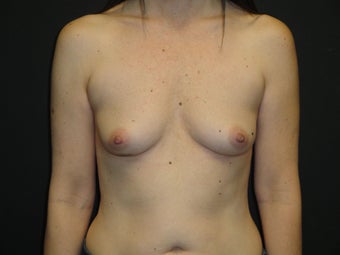Implant-based breast reconstruction