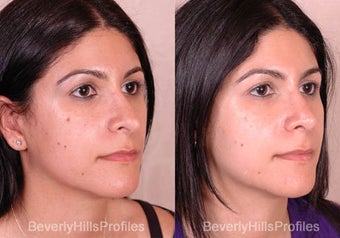 Revision Rhinoplasty