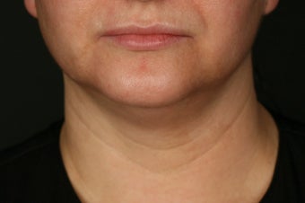 SmartLipo MPX