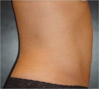 SmartLipo