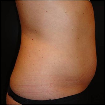 SmartLipo