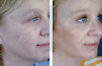 Complete Facial Rejuvenation