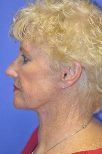 Woman, skin rejuvenation with injectable fillers
