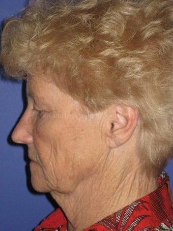 Woman, skin rejuvenation with injectable fillers