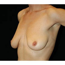 Breast LIft and Implants