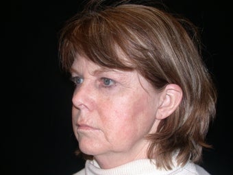 Brow Lift