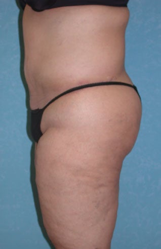 Circumferential Body Lift