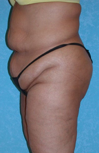 Circumferential Body Lift