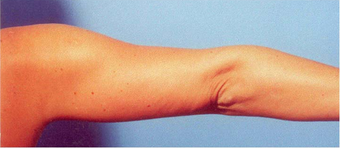 Arm Liposuction