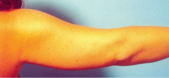 Arm Liposuction