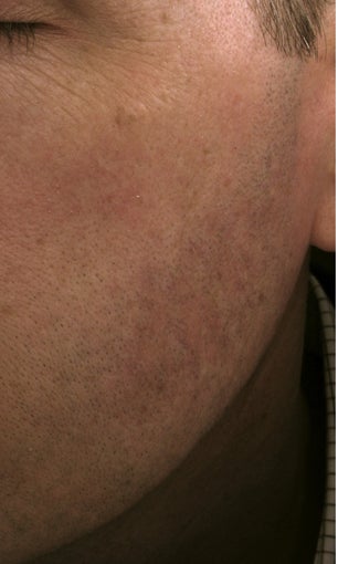 Cheek vessels treated with pulsed dye laser (PDL)
