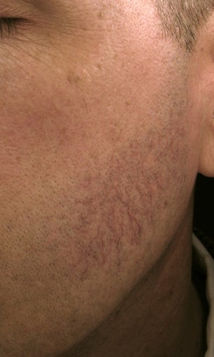 Cheek vessels treated with pulsed dye laser (PDL)