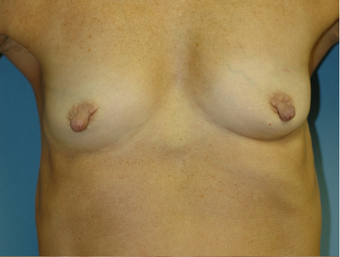 Nipple Reduction