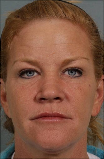 46 year old female with crows feet, loss of lip volume with smokers lines, heaviness of upper eye lids