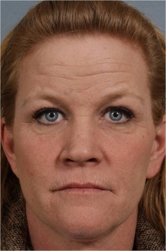 46 year old female with crows feet, loss of lip volume with smokers lines, heaviness of upper eye lids