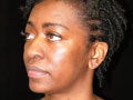 Atlanta Rhinoplasty Patient