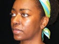 Atlanta Rhinoplasty Patient