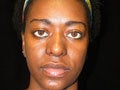 Atlanta Rhinoplasty Patient